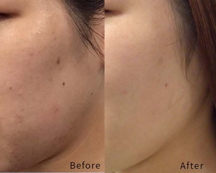 Before and after photos of fece skin 
care
